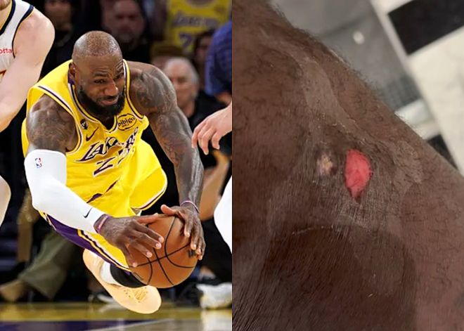 詹姆斯曬傷口喊疼！調侃今年救球到此結束 祝賀東契奇當選周最佳